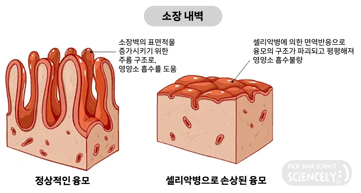 셀리악병 손상 융모 소장벽 글루텐 염증반응 영양실조