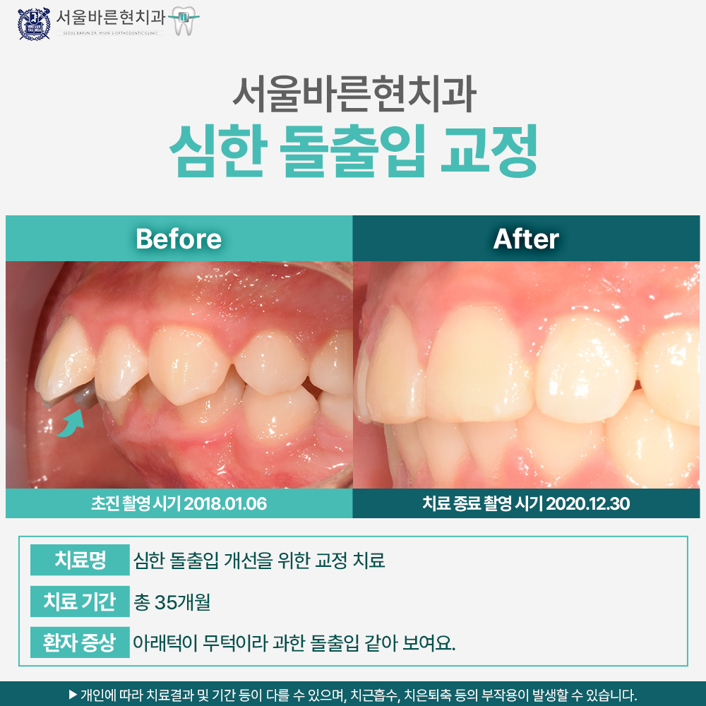 해운대돌출입교정