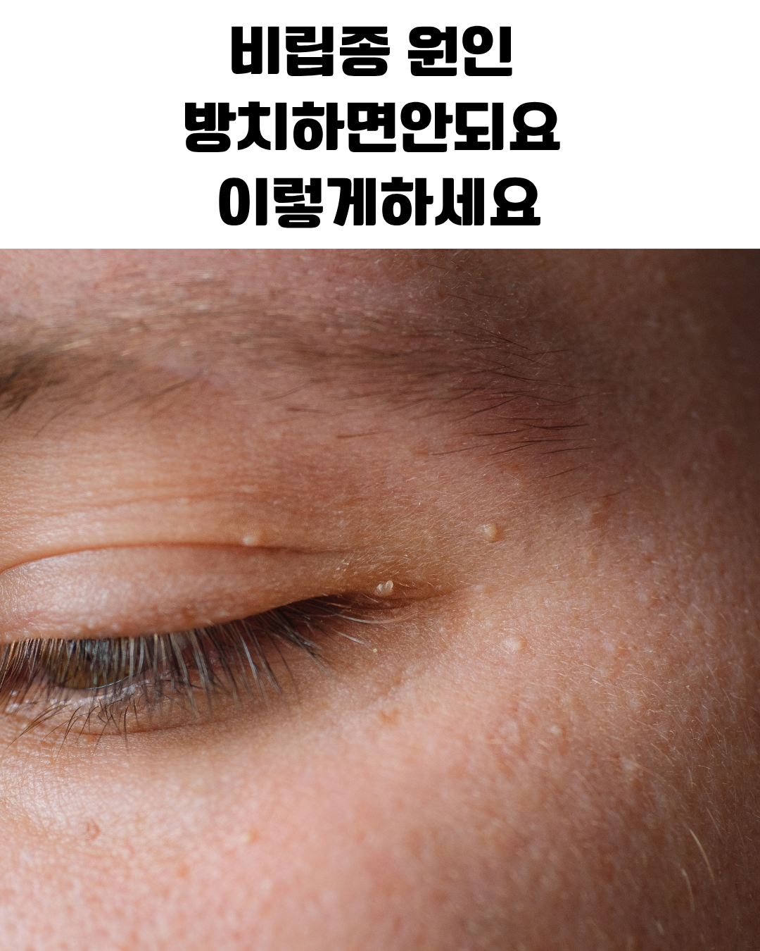 비립종 원인과 올바른 관리 방법 설명 이미지로 눈가 피부에 생기는 각질 낭종의 발생 부위와 피부과 제거 과정을 나타낸 피부 관리 정보 그래픽
