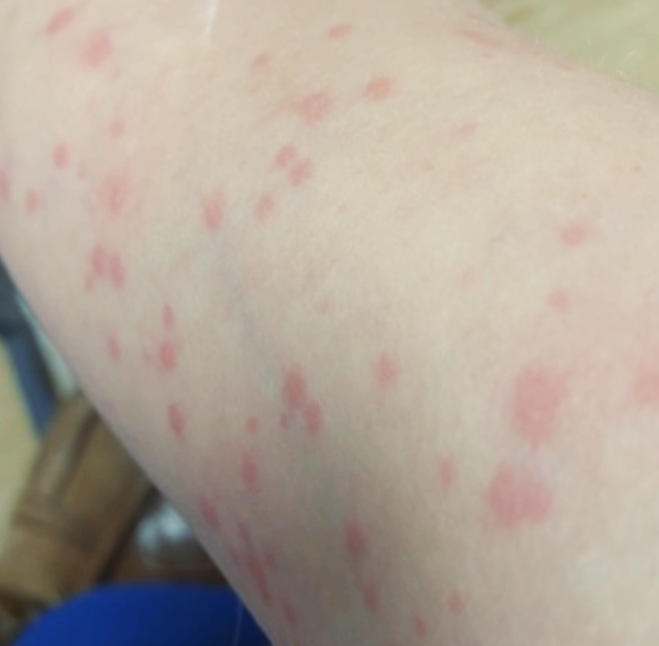 아나필락시스란?