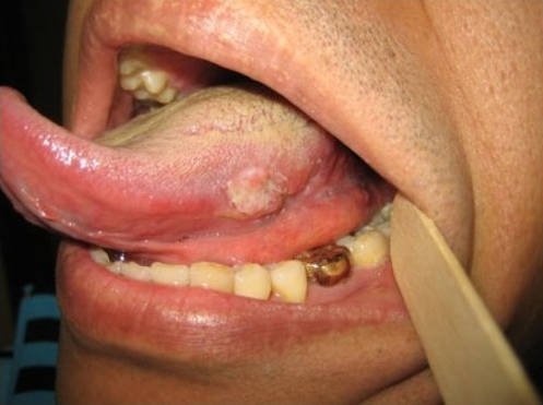 설암(혀암) 초기증상과 원인