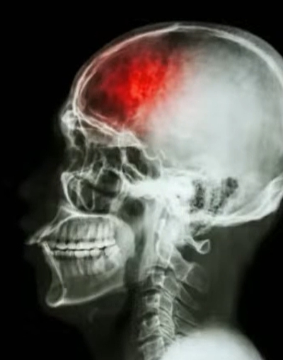 뇌경색 전조증상