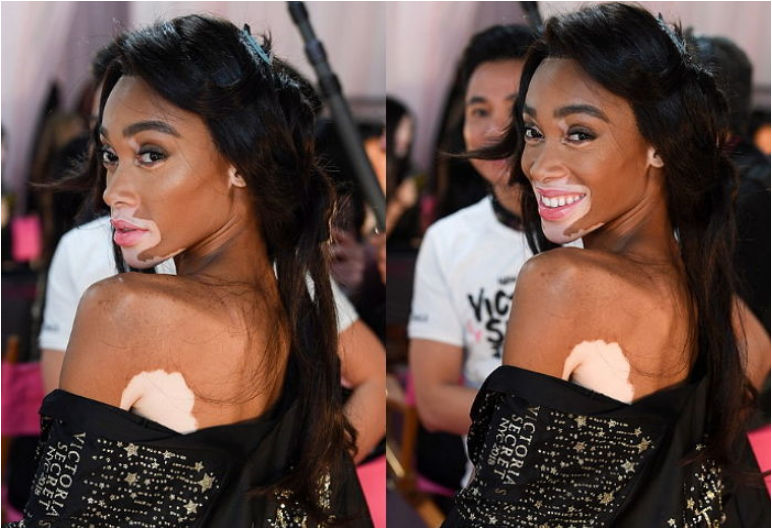 백반증-증상-유전성-진단-치료-명의-리스트