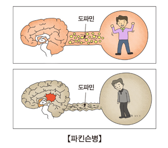 파킨슨병-초기증상-치료방법