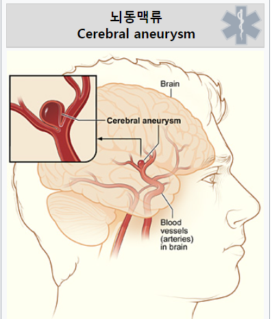 뇌동맥류