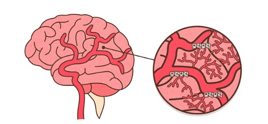 모야모야병 증상8