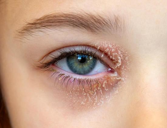 눈꺼풀염(Blepharitis) – 원인, 증상, 치료법
