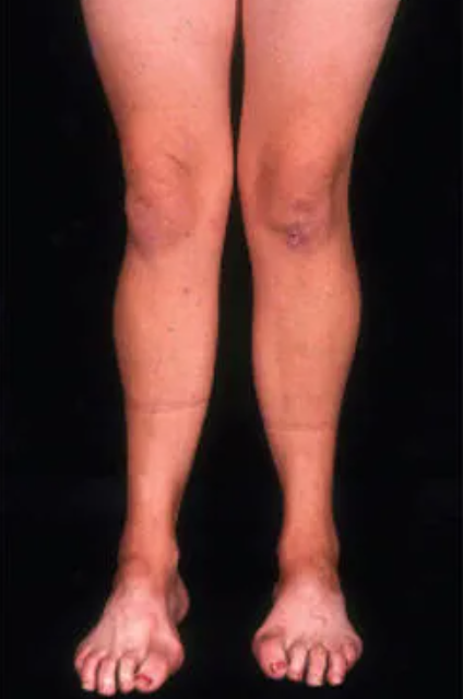 샤르코마리투스