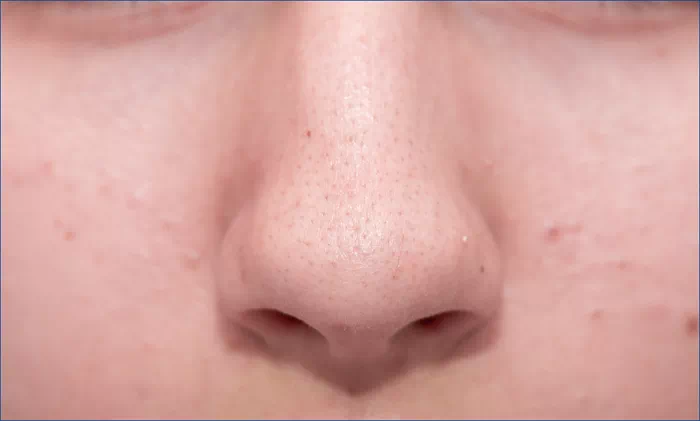 얼굴 모공각화증