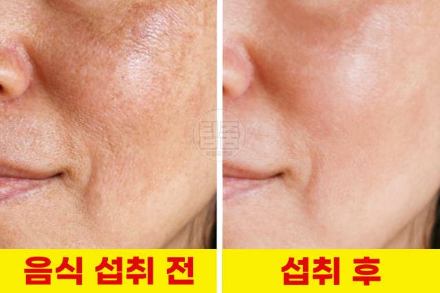 색소침착 제거 좋은 음식,색소침착 레이저 후기,색소침착 자연치유