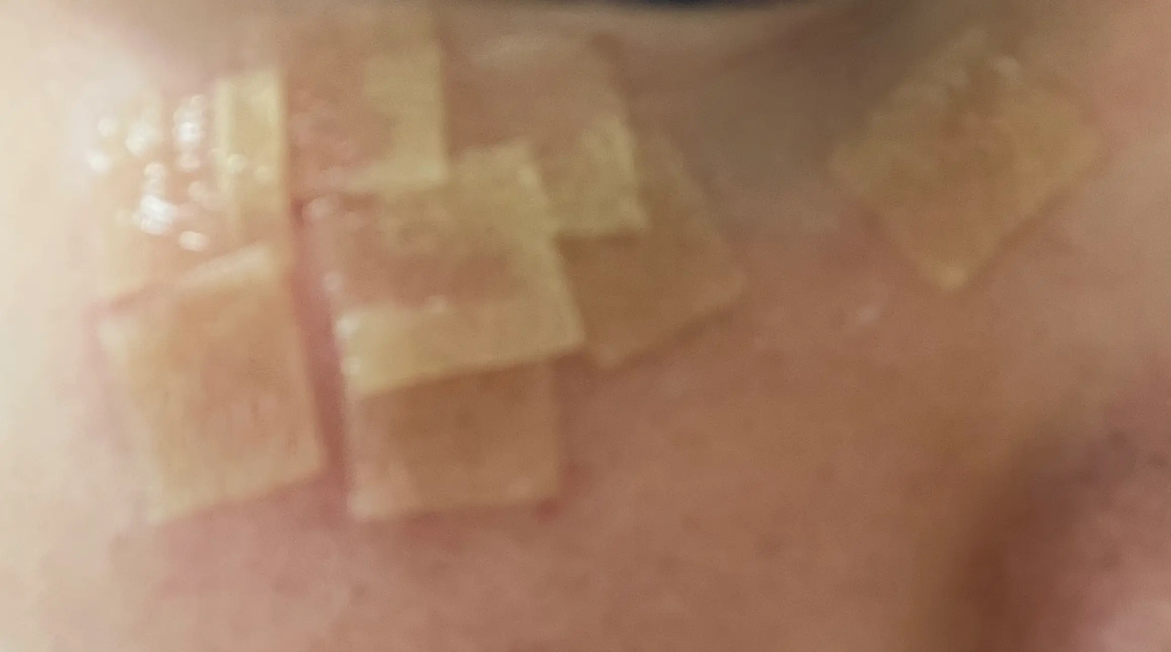 얼굴에-난-비립종-치료-후-사진