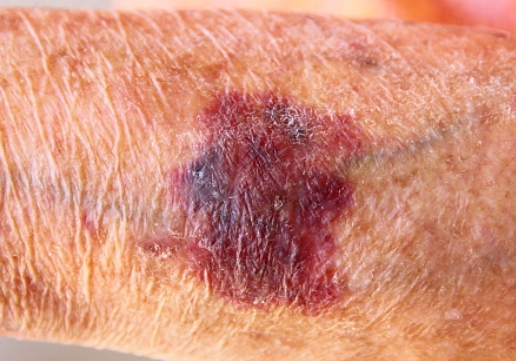 소론도정 부작용