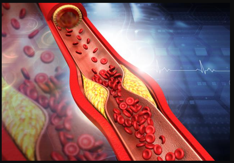 혈관 좁아진 그림