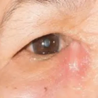 눈물샘 뚫는 수술 간단한가요에 대한 수술정보_21