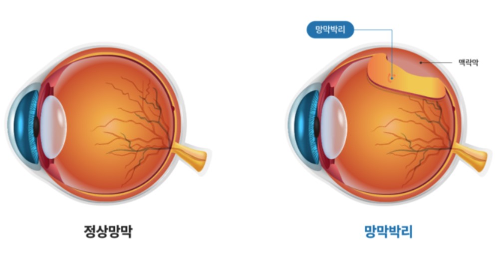 망막박리