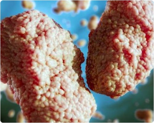 엠폭스 증상 및 원인