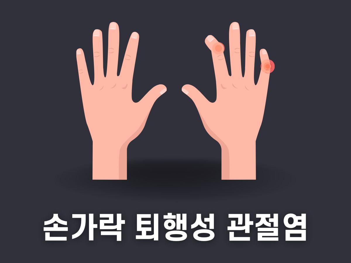 손가락 퇴행성 관절염