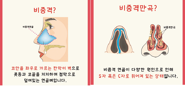 비중격 만곡증