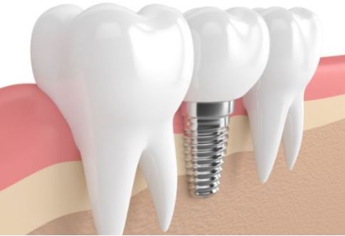 오스템-임플란트