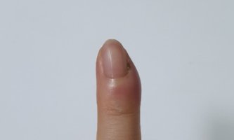 조갑주위염