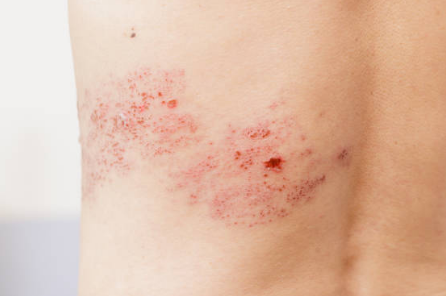 대상포진 증상&amp;#44; 전염&amp;#44; 치료방법 총정리 (2024ver)