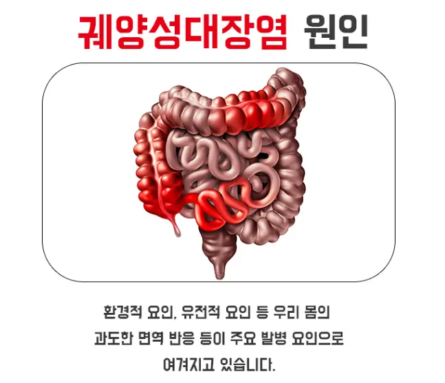 궤양성 대장염 원인