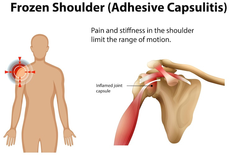 어깨회전근개파열