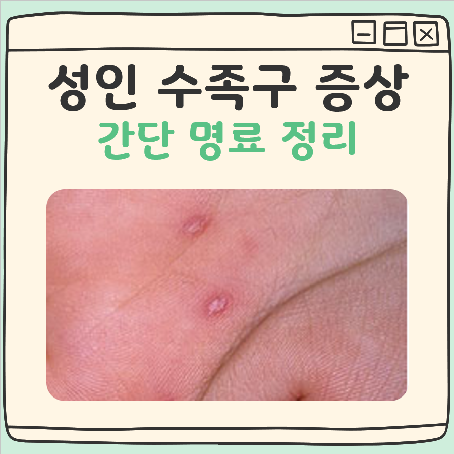 성인 수족구 증상 대표 이미지