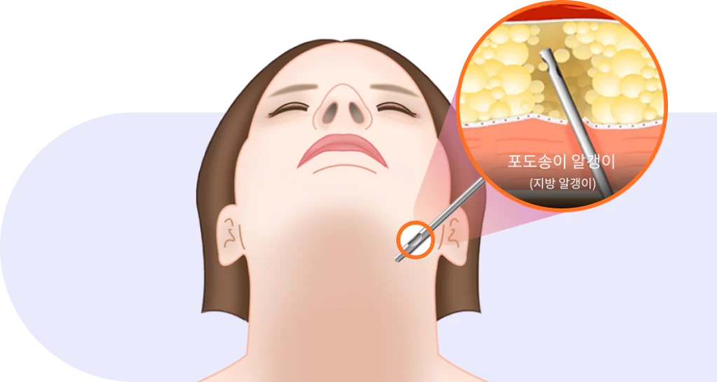 턱선 지방 흡입