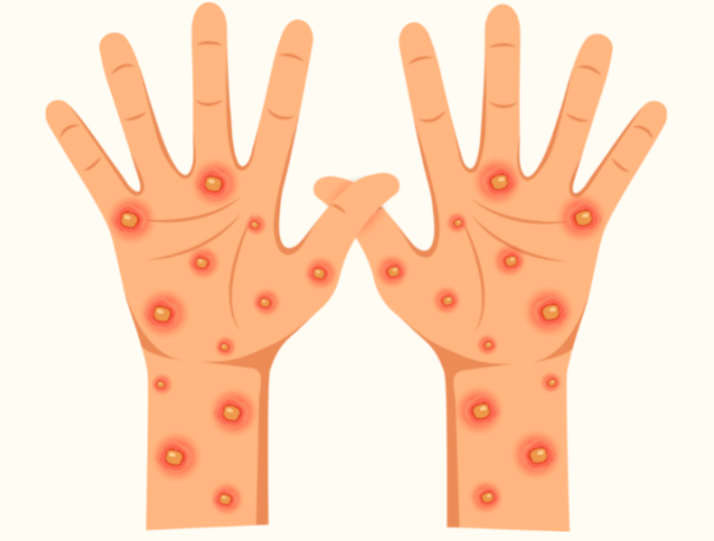 가와사키병의 발병 원인