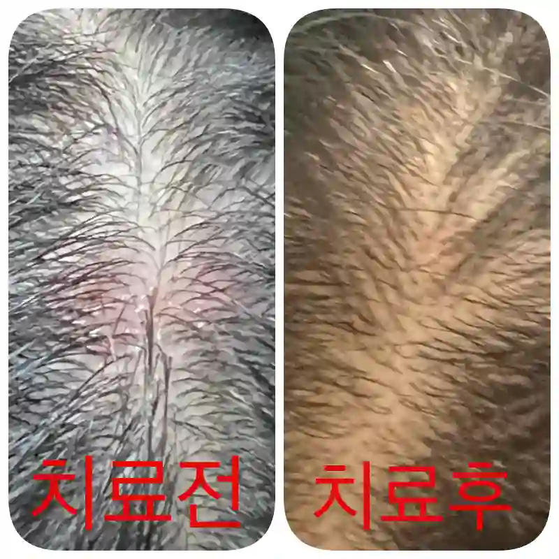 우리 아이에 생긴 모낭염 치료 전후 사진 후 사진 입니다.