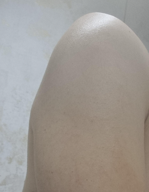 폼클렌징으로 팔뚝 여드름 없애기
