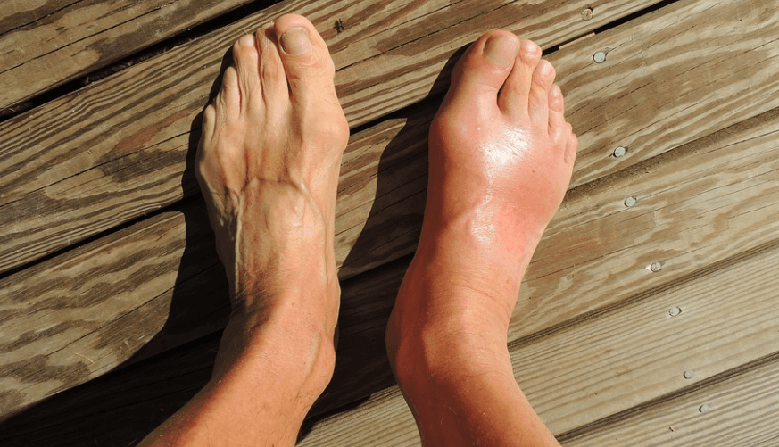 발등이 붓는 이유가 되는 통풍으로 고통을 받고 있는 모습