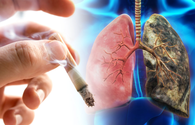 폐암 초기증상 폐결절 폐암원인 예방 금연효과 폐건강 조기검진 호흡기질환 건강관리 조기발견