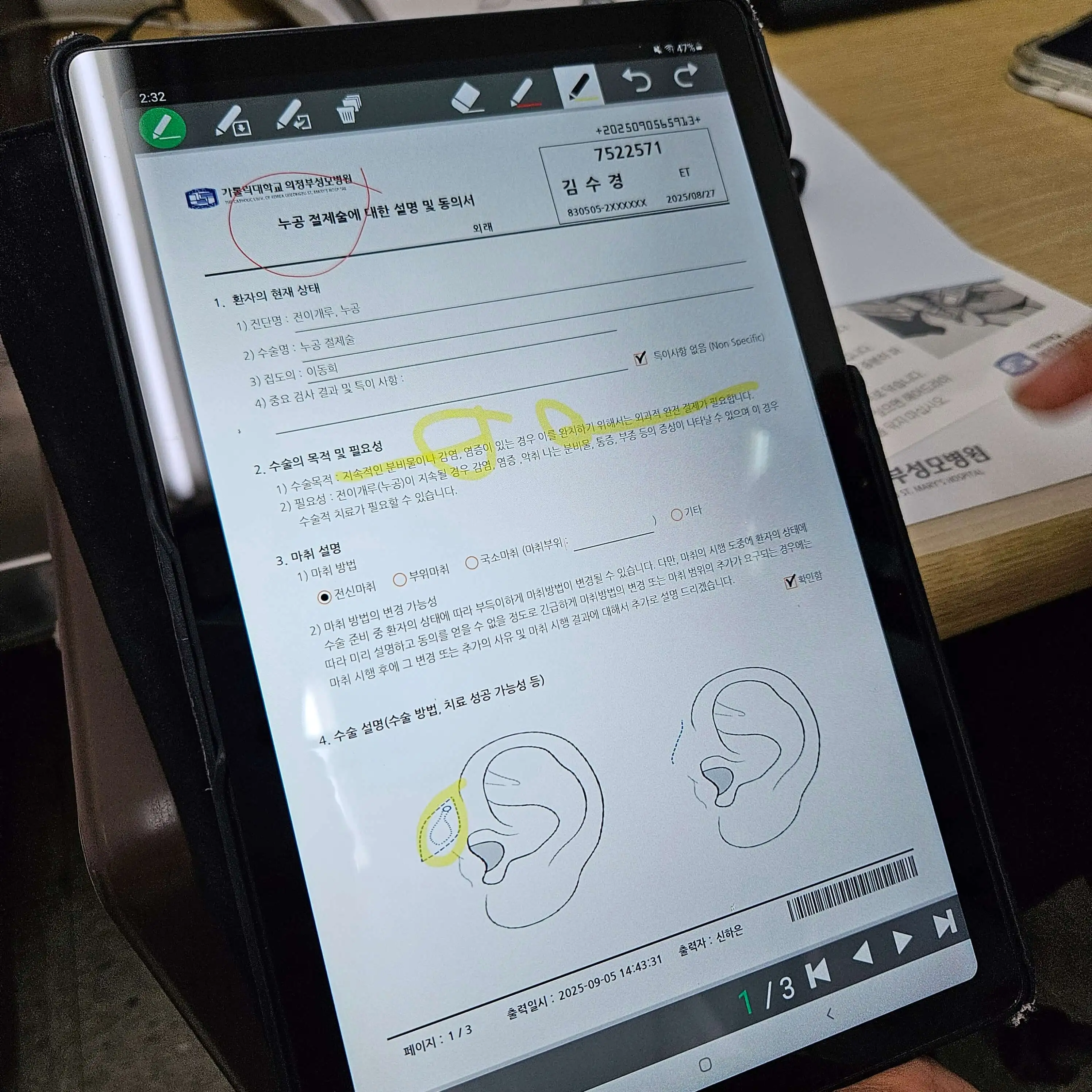 [성모병원 수술후기] 선천성 이루공 전신마취 수술&amp;#44; 의정부성모병원 입원 리얼경험
