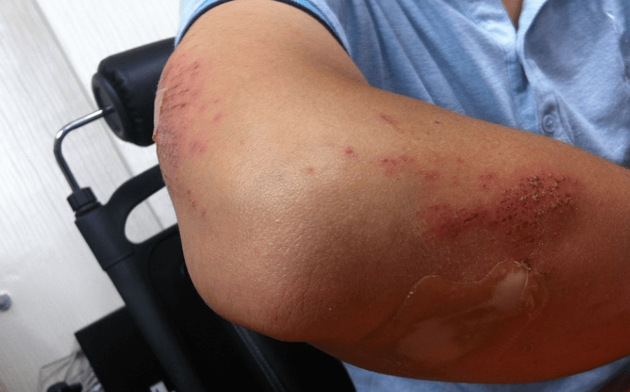 멍이 잘 드는 이유로 팔에 여러 상처가 나 있는 남자