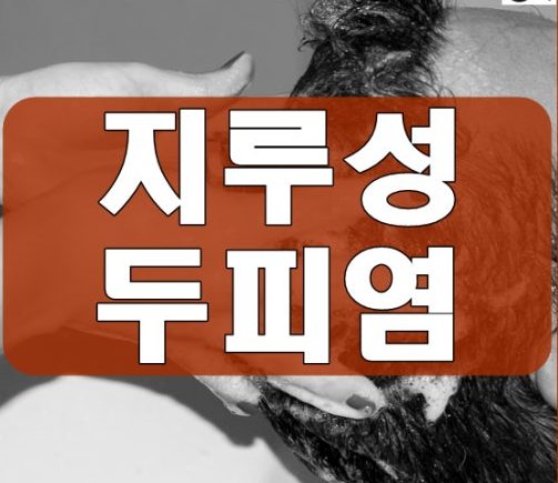 지루성두피염 샴푸 아기 지루성두피염 샴푸