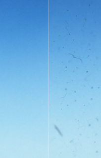 눈에날파리-보임-원인-증상-비문증-구별-치료방법