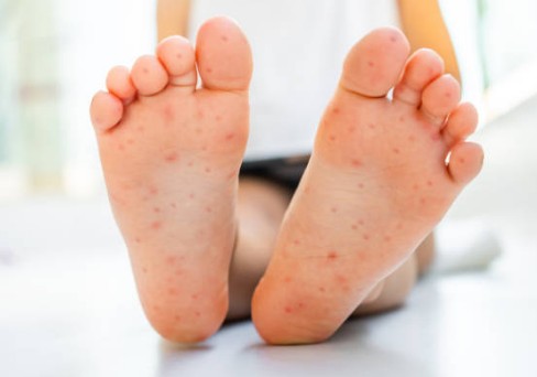 수족구 증상이 발바닥에 나타남