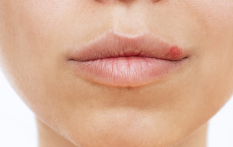 입술에 물집이 생기는 이유 6