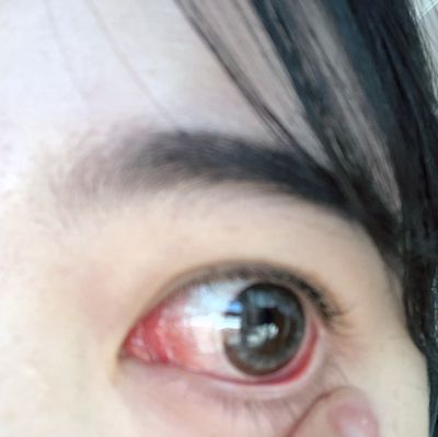 눈 혈관이 터지는 이유