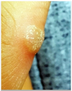 사마귀 제거방법