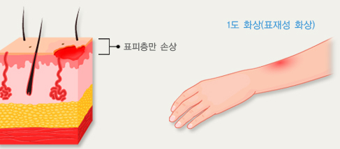 1도 화상 설명