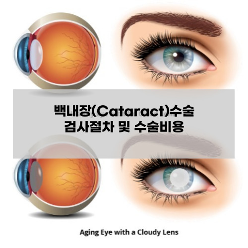 백내장 검사