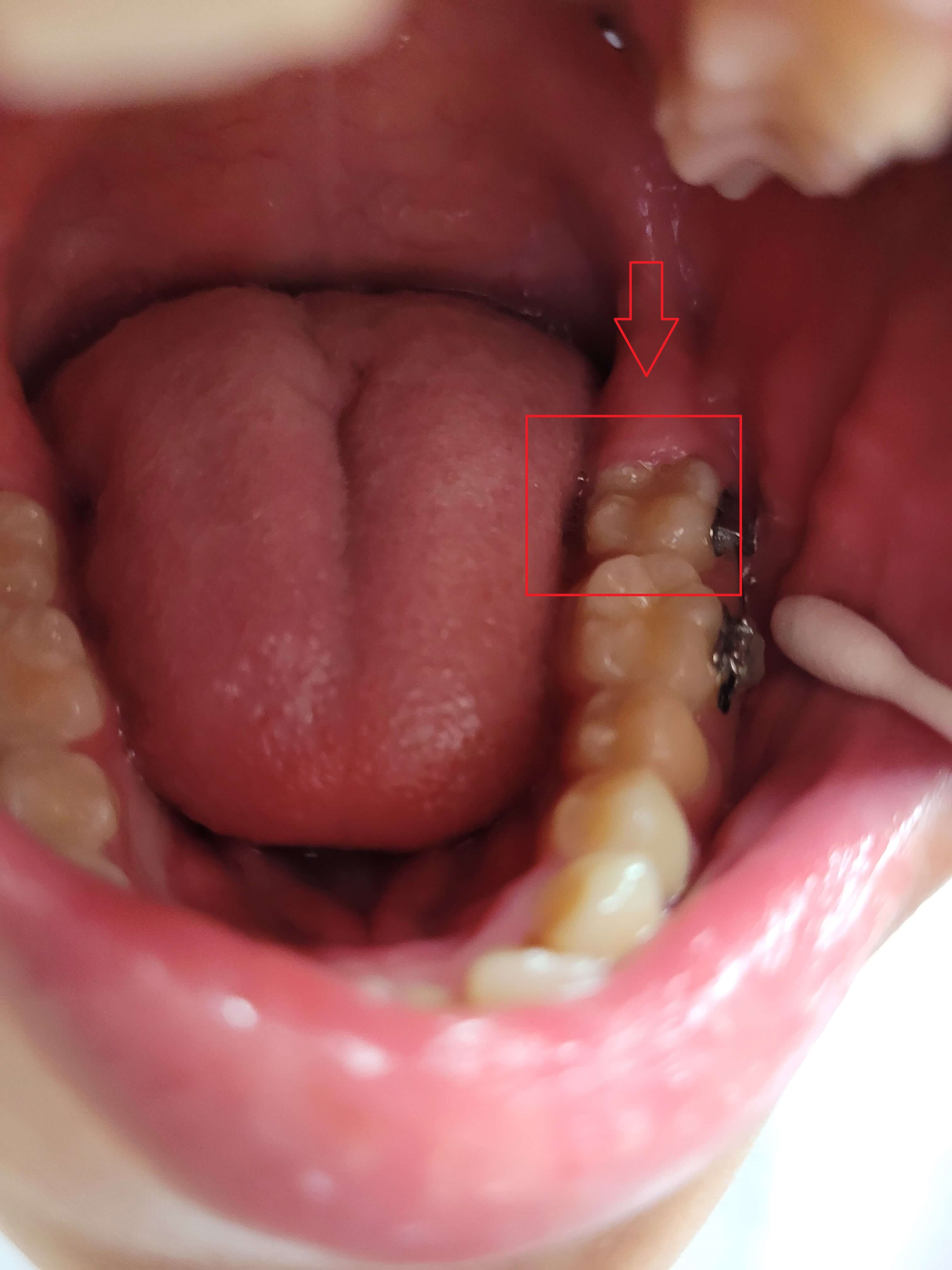 부정교합 가위교합 과개교합 치아교정 후기12