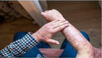 피부 건조증 각질