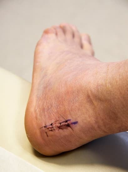 아킬레스건 수술