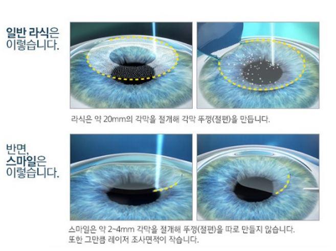 스마일 라식 비용