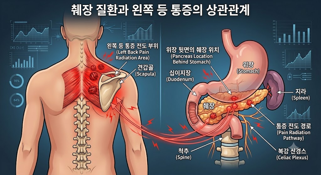 Medical diagram showing the location of the pancreas and how pancreatic issues can cause referred pain in the left upper back.