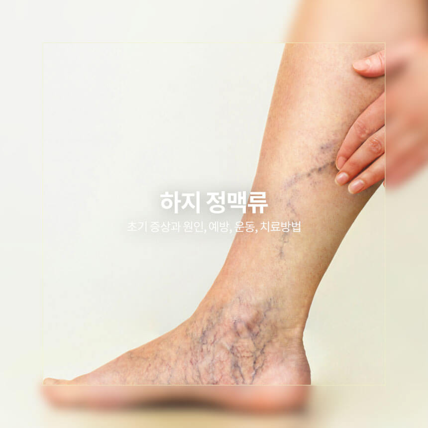 “하지-정맥류-초기증상과-원인-예방-치료방법”